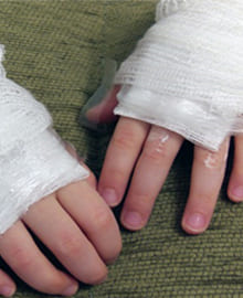 تامین کمک هزینه جراحی پلاستیک صورت سوخته مهدی